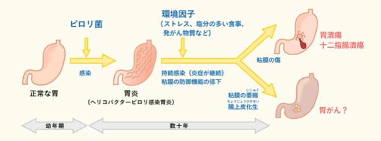 ピロリ菌の症状２